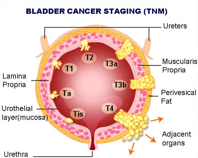 Bladder Cancer staging